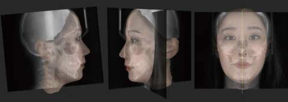 3Dシミュレーション　矯正